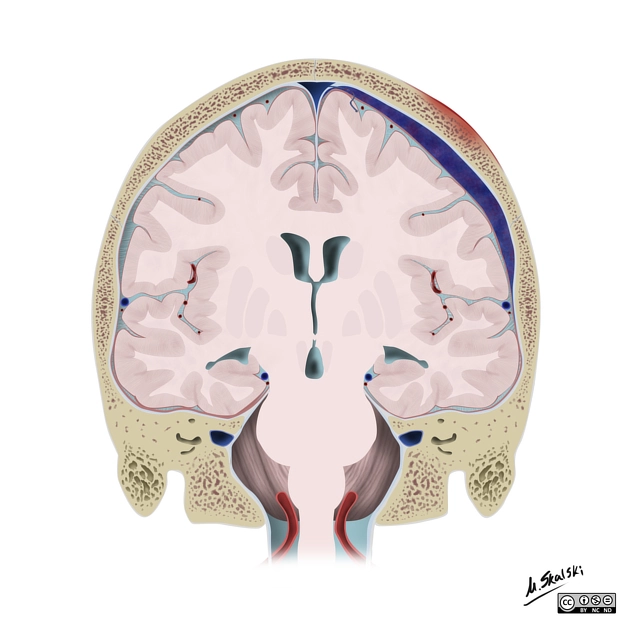 Xuất huyết ngoài màng cứng (Extradural Hemorrhage - EDH)/ Tụ máu ngoài màng cứng (Epidural Hematoma)
