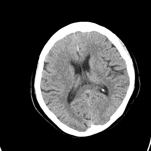 U hạt Wegener ở mũi (Granulomatosis with polyangiitis)