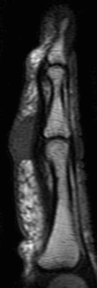 U tế bào khổng lồ bao hoạt dịch gân (Tenosynovial giant cell tumor - TGCT).