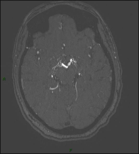 Bệnh hồng cầu hình liềm (Biểu hiện ở não) - Sickle cell disease (cerebral manifestations)