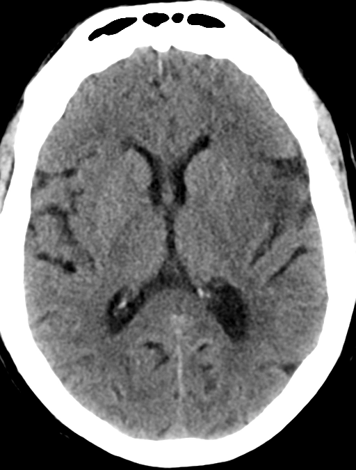 Protocol Chụp CT trong Đột Quỵ Cấp (Stroke Protocol - CT)