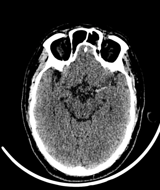 Nhồi máu não giai đoạn cấp (Acute Cerebral Infarction)