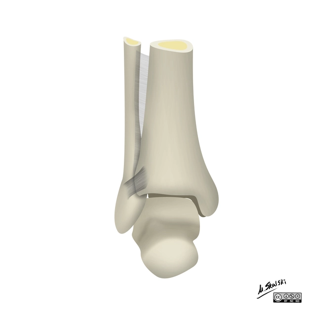 Phân loại Weber gãy đầu dưới xương mác (Weber classification of ankle fractures)