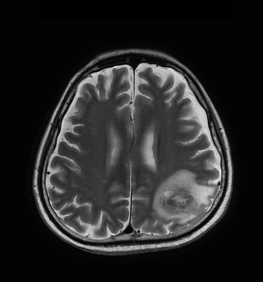 Bệnh amip hệ thần kinh trung ương (CNS amebiasis)