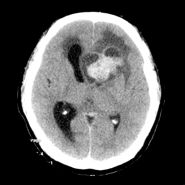 U màng não thất trên lều (Supratentorial Ependymoma- ST-EPN) 