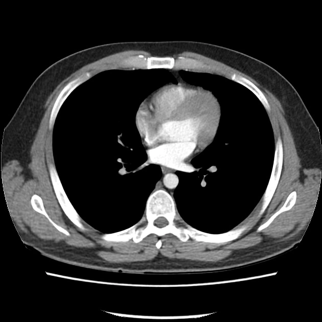 Hình ảnh chụp cắt lớp CT ngực (Computed tomography of the chest) 