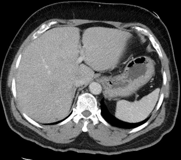 Nang gan đơn giản (Simple hepatic cyst)