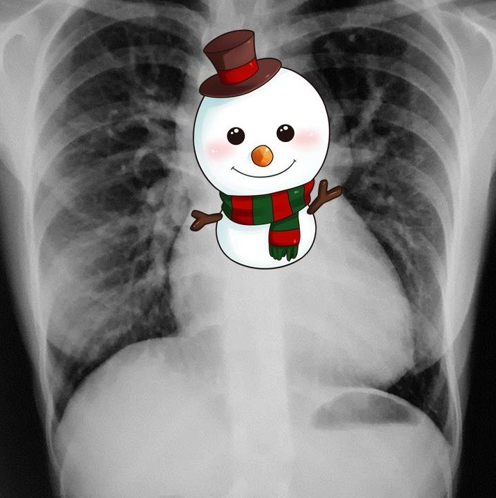 Dấu hiệu Người tuyết (trong Bất thường hồi lưu tĩnh mạch phổi toàn phần) -  Snowman sign (total anomalous pulmonary venous return)