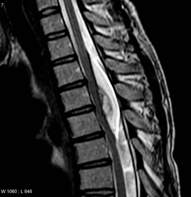 Nang bì cột sống (Spinal dermoid cyst)