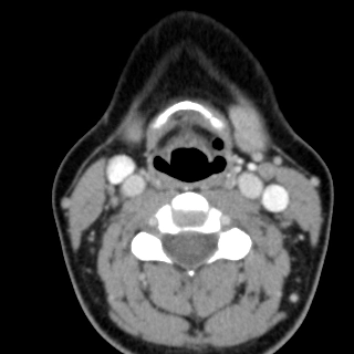Túi khí thanh quản (Laryngocele)