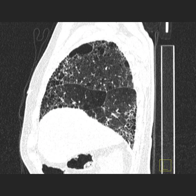 Biến dạng cấu trúc phổi (Lung architectural distortion)