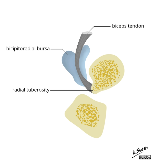 Viêm bao hoạt dịch nhị đầu-quay (Bicipitoradial Bursitis)