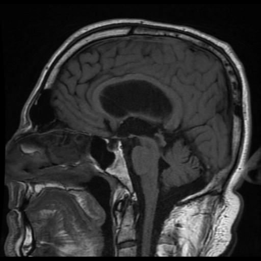 Tổn thương thể chai sau não úng thủy (Post-hydrocephalus Corpus Callosum Damage)