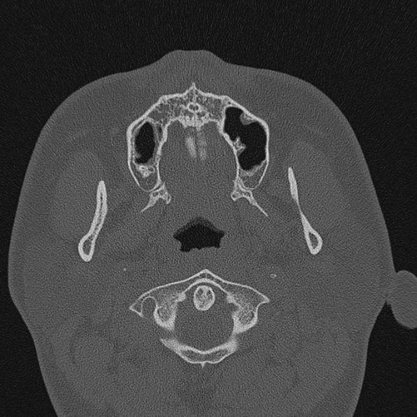 Loạn sản sợi nền sọ (Skull Base Fibrous Dysplasia)