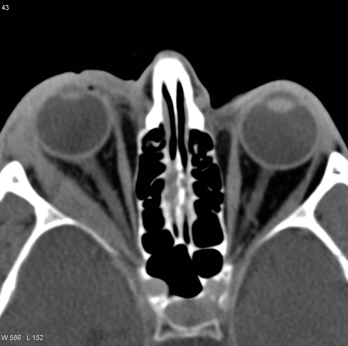 Viêm ổ mắt giả u (orbital pseudotumor)