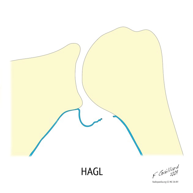 Tổn thương HAGL (Humeral Avulsion of the Glenohumeral Ligament)/ Bong dây chằng ổ chảo-cánh tay dưới