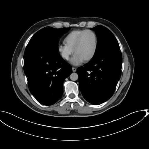 U Desmoid mạc treo (Mesenteric desmoid tumor)