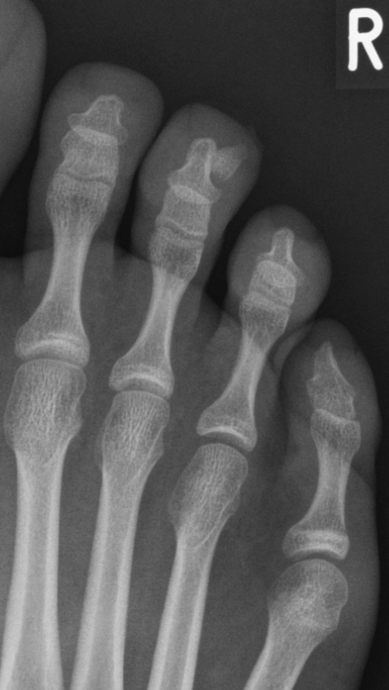 Chồi xương dưới móng (Subungual exostosis)