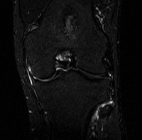 Rách sụn chêm phức tạp (Complex meniscal tear)