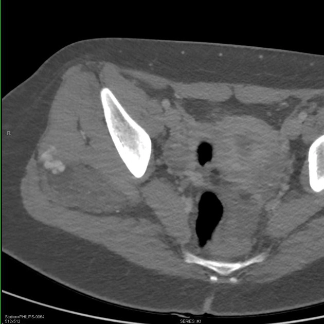 U mỡ nâu (Hibernoma)