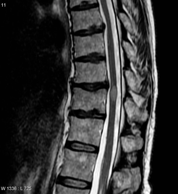 Viêm tủy sống (Myelitis)