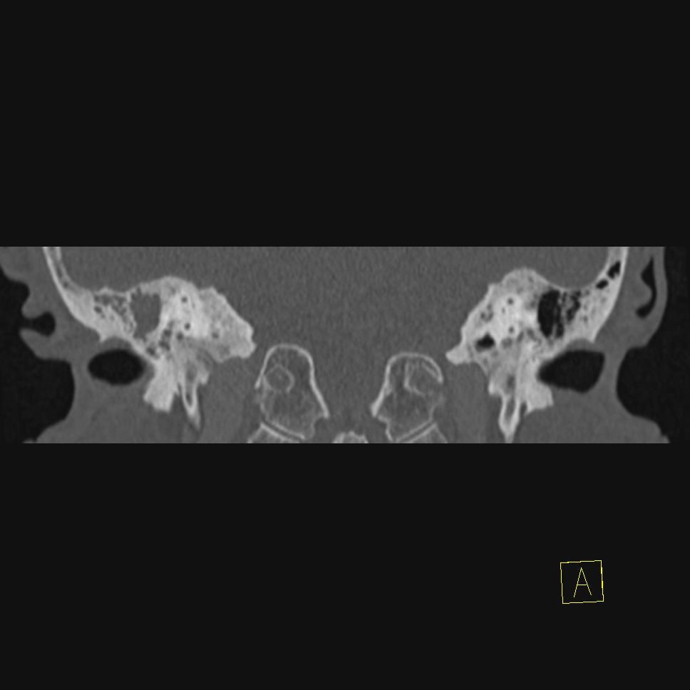Viêm tai-xương chũm mạn tính (Chronic otomastoiditis)