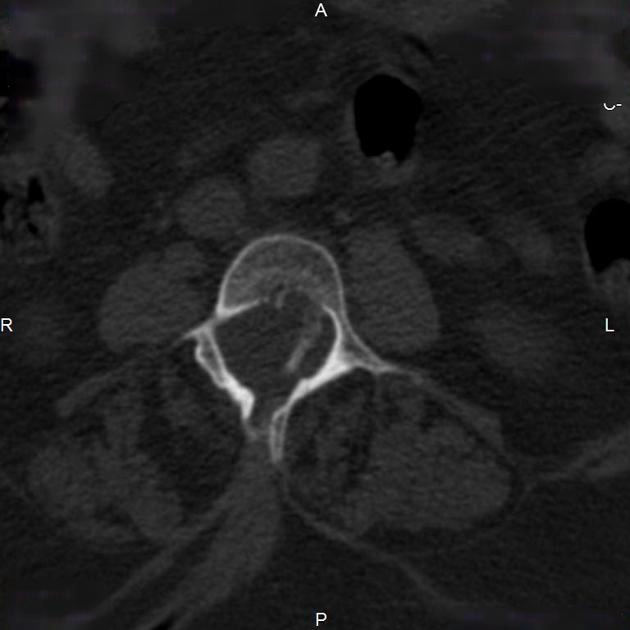 Tật loạn sản ống sống (Spinal dysraphism)