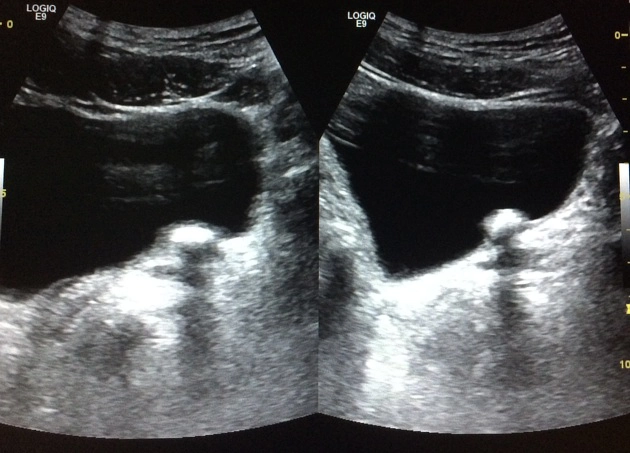 Sỏi niệu quản (Ureteric calculi)