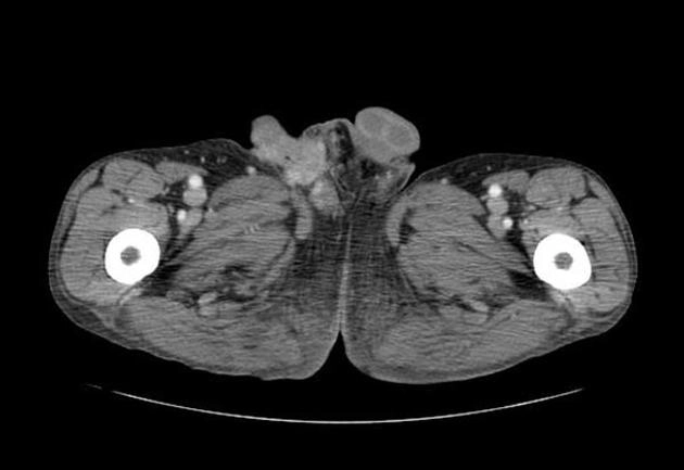 Sarcoma sợi bì lồi (Dermatofibrosarcoma Protuberans - DFSP)