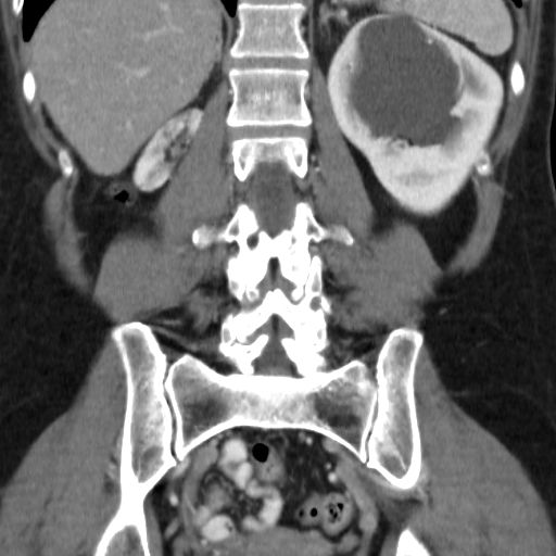 Thiểu sản thận (Renal hypoplasia)