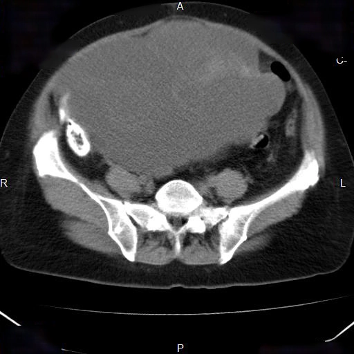 Tổng quan các khối u biểu mô buồng trứng (Ovarian epithelial tumors)