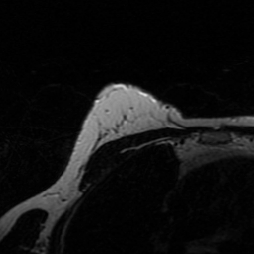 U mỡ tuyến vú (Breast lipoma)