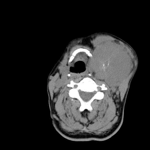 U vỏ bao thần kinh ngoại biên ác tính vùng cổ (Malignant Peripheral Nerve Sheath Tumor of Head and Neck)