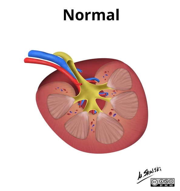 Phân độ chấn thương thận AAST (AAST kidney injury scale)