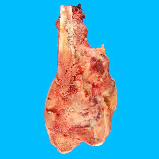 Sarcoma xương (Osteosarcoma) 