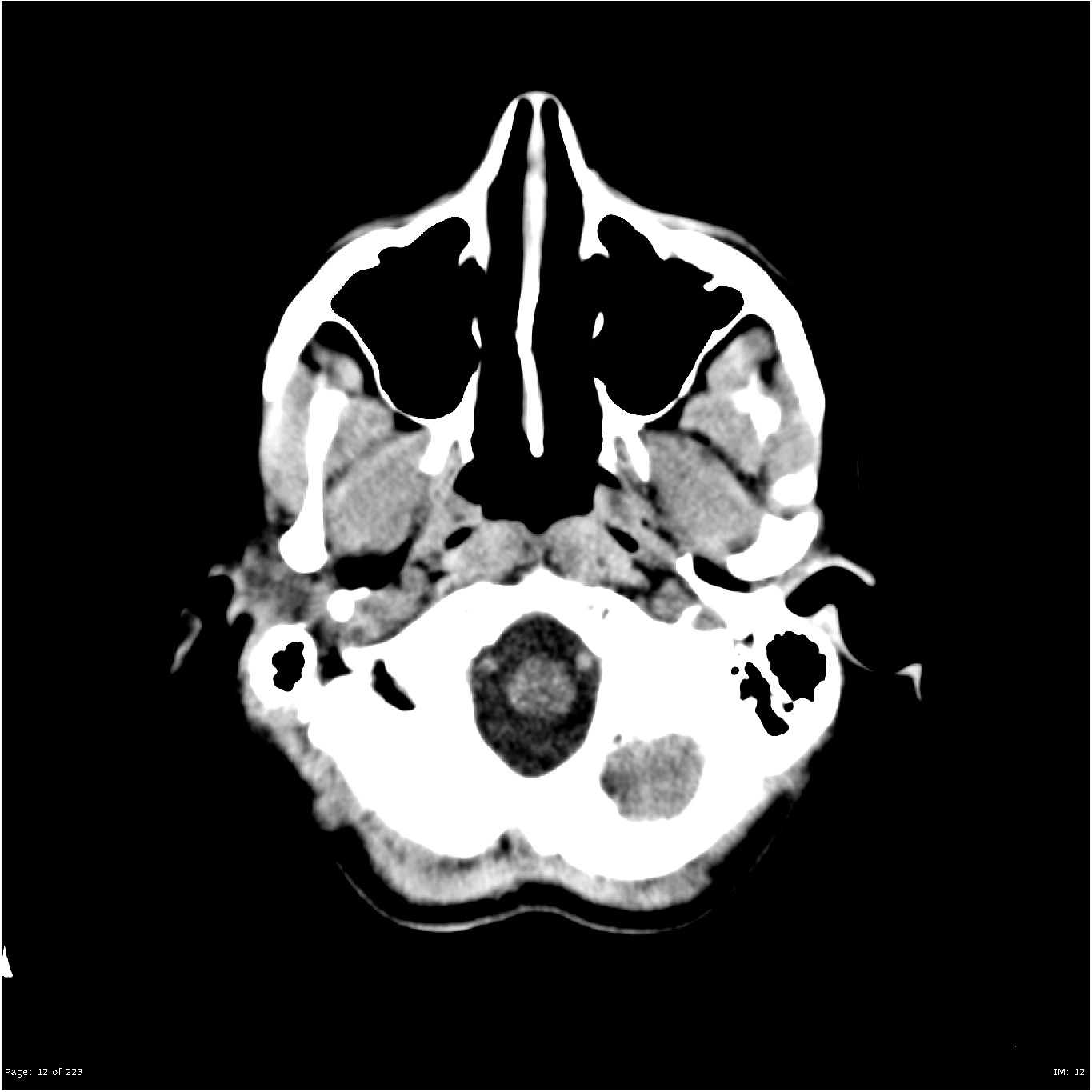 Nang thượng bì góc cầu tiểu não (CPA-IAC Epidermoid Cyst)
