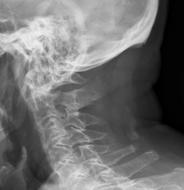 Cốt hóa dây chằng gáy (Sesamoid ossicles of the nuchal ligament)