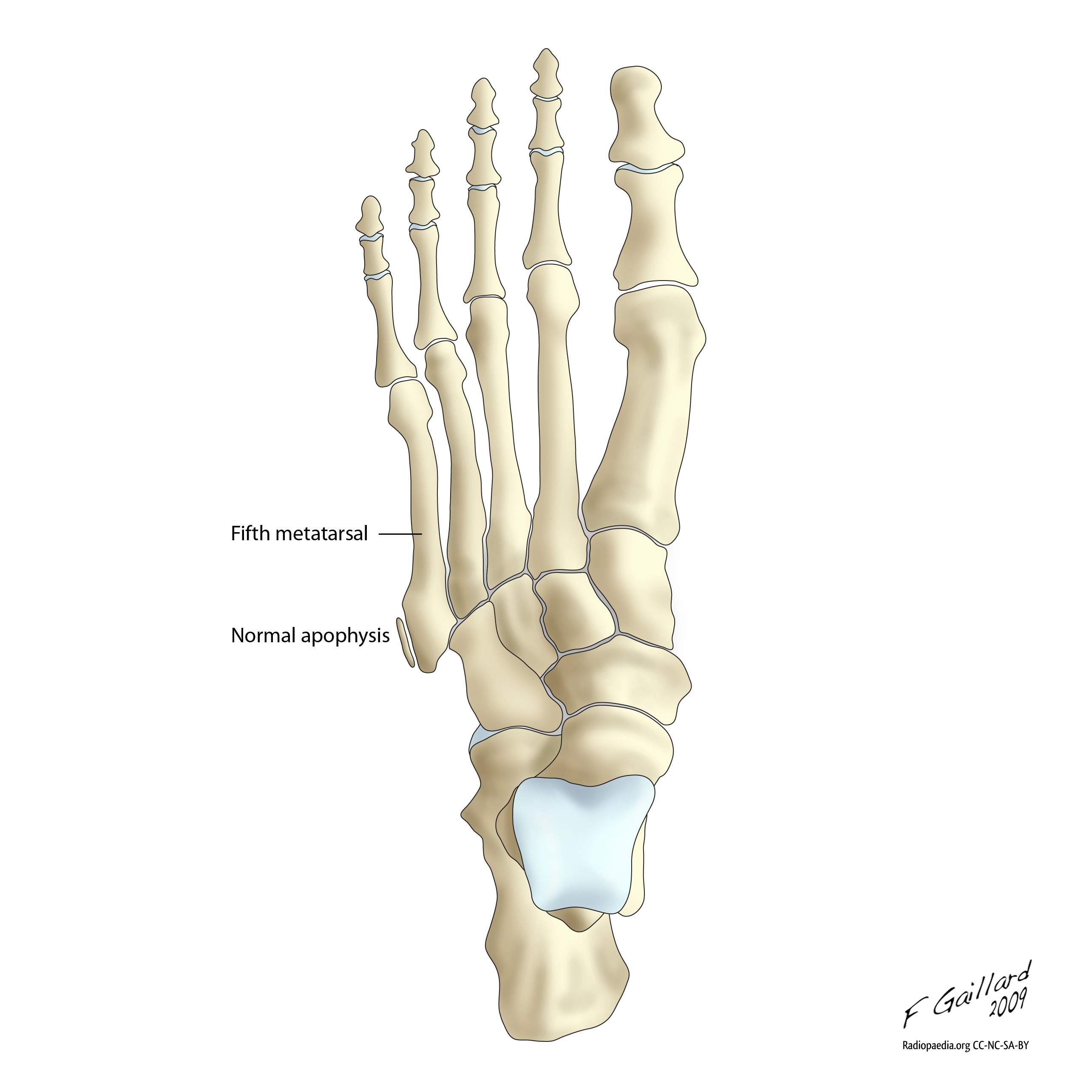 Mảnh sụn tiếp hợp nền xương bàn ngón 5 (Apophysis of the proximal 5th metatarsal)