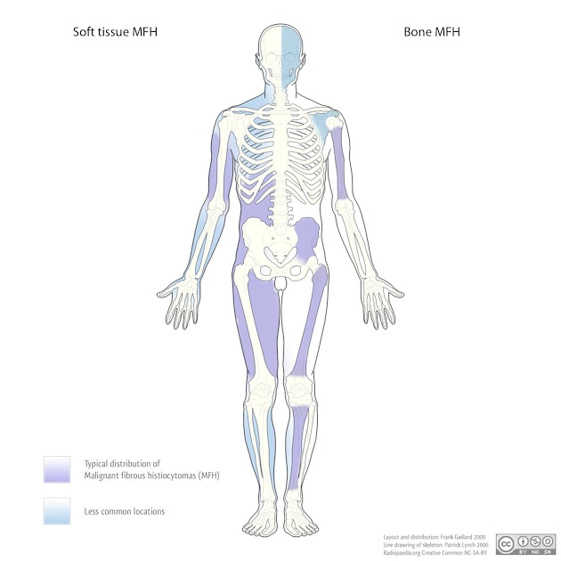 U sợi ác tính (Malignant Fibrous Histiocytoma - MFH)/ Sarcoma đa hình thái không biệt hóa (Undifferentiated Pleomorphic Sarcoma - UPS)
