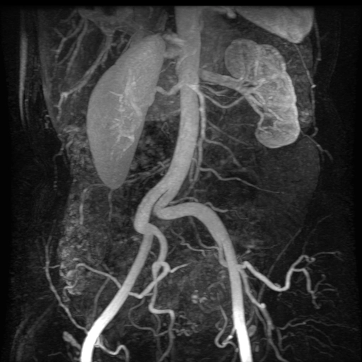 Thùy phôi thai thận (Persistent fetal lobulation of the kidneys)