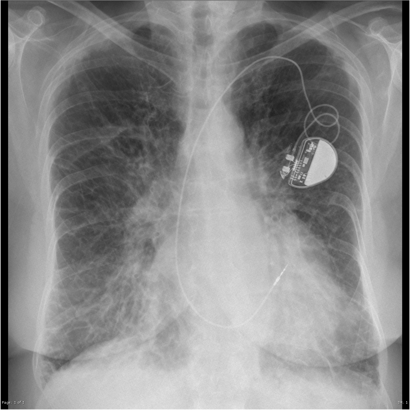 Các đường vách phổi / Đường Kerley (Septal lines in lung)