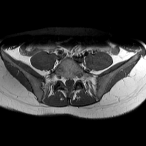 Viêm khớp cùng chậu (Sacroiliitis)