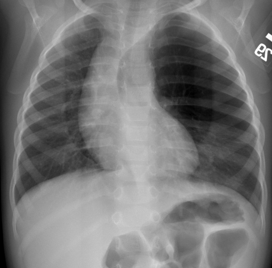 Ứ khí thùy phổi bẩm sinh (Congenital lobar overinflation - CLO)