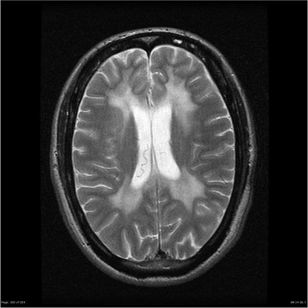 Bệnh loạn dưỡng chất trắng dị sắc (Metachromatic Leukodystrophy - MLD)