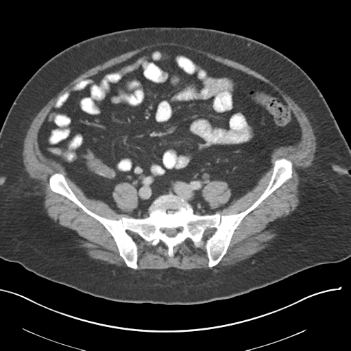 U tân sinh ruột thừa (Appendiceal neoplasms)