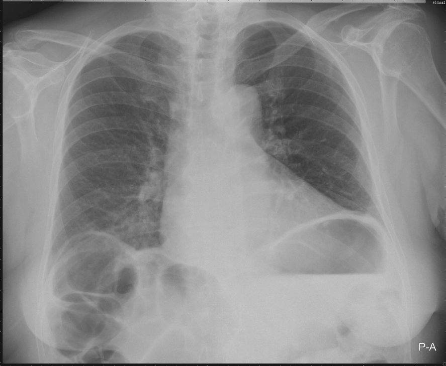 Hội chứng Chilaiditi (Chilaiditi syndrome)