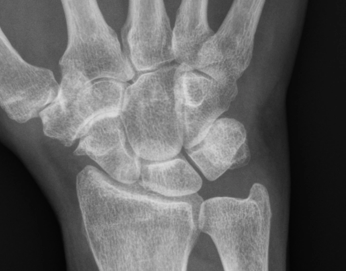 Thoái hóa khớp thuyền-thang-cả (Scaphotrapeziotrapezoidal - STT joint arthritis)