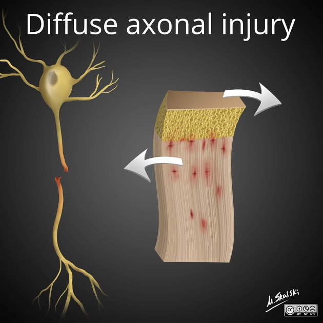 Tổn thương sợi trục lan tỏa (Diffuse Axonal Injury - DAI)