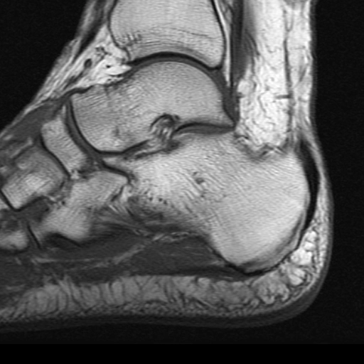 Rách cân gan chân (Plantar fascial tears)