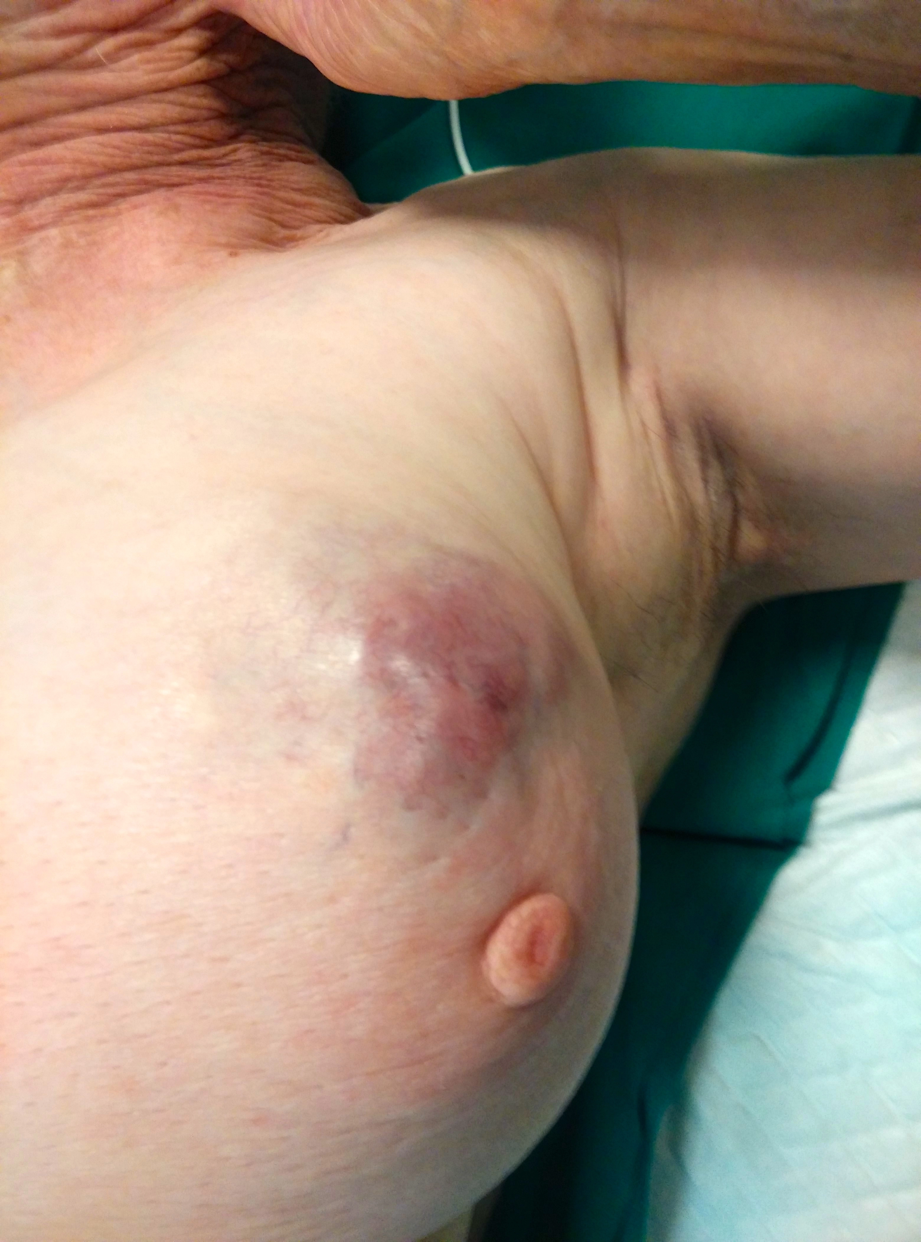U lympho của vú (Breast lymphoma)
